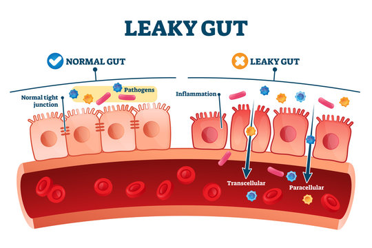 leaky-gut